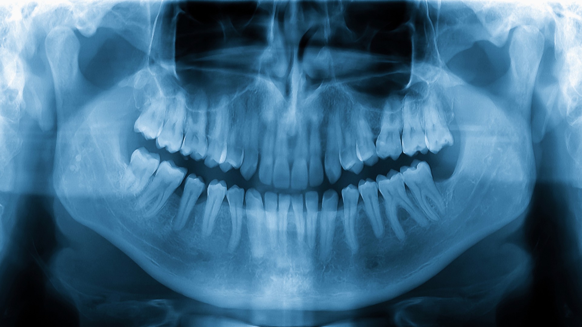 Dientes en 1 día: qué es la prótesis inmediata y para quién
