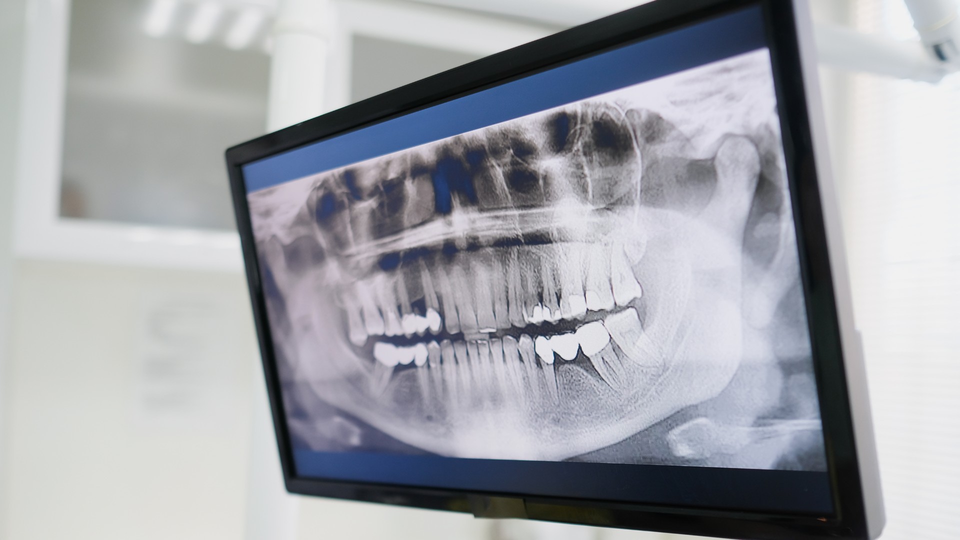 Dientes en 1 día: qué es la prótesis inmediata y para quién